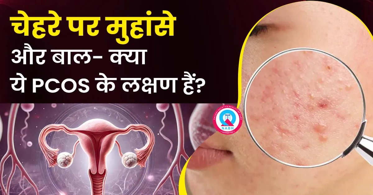चेहरे-पर-मुहांसे-और-बाल-क्या-ये-PCOS-के-लक्षण-हैं